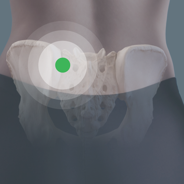 SI joint dysfunction generally refers to pain in the hip region caused by abnormal motion in the sacroiliac joint. This is thought to cause chronic low back pain, groin pain, and leg pain, impacting one’s quality of life.